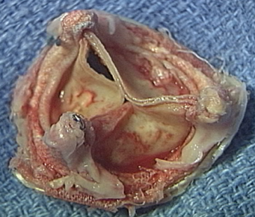 AKE bio entzündlich degenerativ AKE bio entzündlich degenerativ